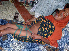 Genital mutilation in Somalia (photo: picture-alliance/dpa)