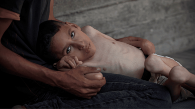 A malnourished boy lies in the arms of an adult and stares blankly into the camera.